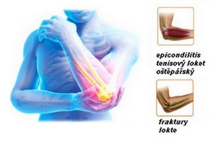 obsah-apo-elbow-injury.jpg