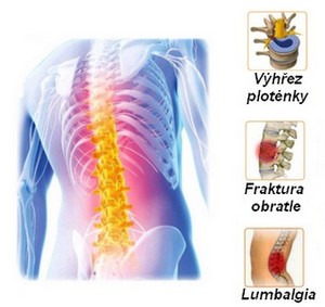obsah-apo-spine-syndroms.jpg